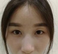 寧波尚麗姜艷做雙眼皮果怎么樣？親生經(jīng)歷恢復(fù)果圖供參考