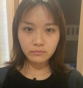 做完眼部綜合手術(shù)后果滿意，想要記錄一下自己變美的歷程