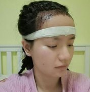 在成都恒博種植發(fā)際線后，60天了恢復(fù)果前后變化大