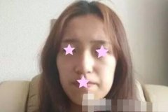 北京加減美整形價格表_附面部脂肪填充案例恢復果圖