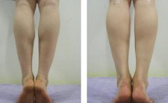 小腿抽脂后幾天能走路？恢復(fù)時間及術(shù)后護(hù)理盤點(diǎn)