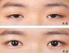 眼瞼下垂的種類有哪些？矯正方法及注意事項分享