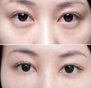微創(chuàng)去眼袋的果好嗎？優(yōu)點(diǎn)和副作用大盤點(diǎn)