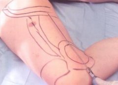 腿部抽脂多久可以恢復(fù)？術(shù)后注意事項(xiàng)有哪些？