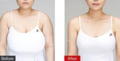 縮胸手術(shù)的價格是多少錢？哪些人適合做縮胸？