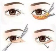 外切去眼袋外翻多久會(huì)好？術(shù)后護(hù)理方法有哪些？