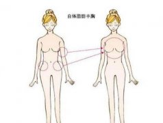 自體脂肪豐胸多少錢？這三個因素是造成價格差異的原因