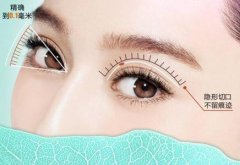 做吸雕雙眼皮要注意些什么？此手術(shù)不適合的人群有哪些？