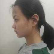 上海市第六人民醫(yī)院整形好不好？做隆鼻案例真實(shí)果反饋