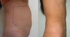 水動力吸脂和360環(huán)吸的區(qū)別