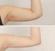 手臂吸脂多久恢復(fù)?手臂抽脂需要多久才能恢復(fù)?