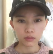 杭州同榮麗格隆鼻案例怎么樣?分享術(shù)前術(shù)后果圖_恢復(fù)過(guò)程心得