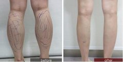 小腿抽脂的費(fèi)用是多少呢?果明X嗎?