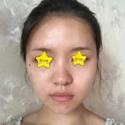 南京美萊趙其中鼻修復(fù)怎么樣？來看看案例術(shù)后恢復(fù)照片就知道了