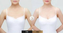 自體脂肪隆胸怎么護理呢?自體脂肪隆胸的風險與預防應該怎么做?