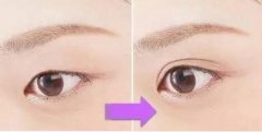 雙眼皮怎么做的?雙眼皮手術(shù)后多久恢復(fù)?