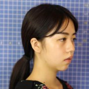 四川人民醫(yī)院東籬醫(yī)院怎么樣？看專家鼻部手術(shù)案例~反饋恢復(fù)果圖