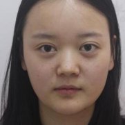 成都素美整形醫(yī)院是正規(guī)醫(yī)院嗎？分享下隆鼻案例術(shù)前術(shù)后對比照片