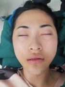 八大處玻尿酸墊下巴的價(jià)格是多少？2021新案例果圖全覽~