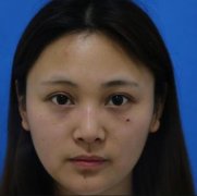 徐州市中心醫(yī)院整形美容中心隆鼻果怎么樣？手術對比照一覽