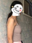 中山市第二人民醫(yī)院整形美容科隆胸案例！術(shù)后恢復(fù)情況果分析