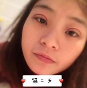 安徽省立醫(yī)院割雙眼皮怎么樣？小姐姐真人案例~術(shù)后恢復(fù)情況對比