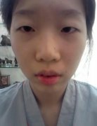 保山市人民醫(yī)院整形雙眼皮案例~附上術(shù)后恢復(fù)果展示