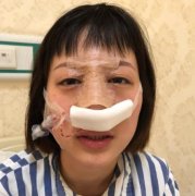 大坪醫(yī)院整形美容科隆鼻失敗修復(fù)口碑好嗎？案例實(shí)拍圖和費(fèi)用一覽