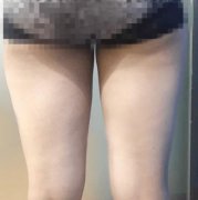 北醫(yī)三院整形科吸脂案例~術(shù)后90天較終果圖分享