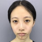 北京安貞楊媚雙眼皮怎么樣？案例圖術(shù)后恢復(fù)記錄新公開~