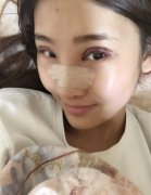 華悅府醫(yī)療美容張鵬眼部手術(shù)+鼻部手術(shù)果怎么樣?對比下案例就知道了