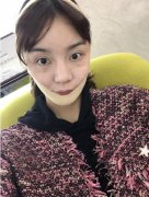 華西醫(yī)院整形美容燒傷科價(jià)目表！含2021新面部吸脂案例恢復(fù)記錄反饋