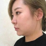 山東省立醫(yī)院整形美容外科注射瘦臉怎么樣？看看案例果圖對比