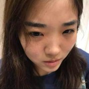 重慶三峽醫(yī)院整形外科水光補(bǔ)水怎么樣？看看案例果圖對比