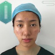 廣州南方醫(yī)院脂肪填充怎么樣？面部脂肪填充案例恢復照片和價格分享