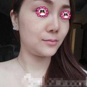 佛山市第一人民醫(yī)院整形美容科注射瘦臉案例~90天真人實(shí)拍圖 