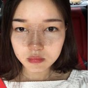 西安美立方做鼻子怎么樣？看看隆鼻整形案例+果圖分享!