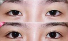 西安開眼角哪個(gè)醫(yī)院好？西安藝星怎么樣？手術(shù)優(yōu)勢(shì)及價(jià)格參考