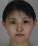 深圳市第二人民醫(yī)院整形美容科注射瘦臉案例_案例術(shù)后果實(shí)拍分享