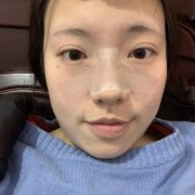 寧波薇琳張廣巍修復(fù)鼻子好嗎？2021案例和價(jià)格表詳情分享