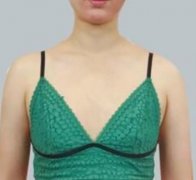 上海港華醫(yī)院隆胸怎么樣？對(duì)比案例圖參考一下