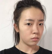 上海美聯(lián)臣整形醫(yī)院鼻部手術(shù)案例果公布！含價(jià)格費(fèi)用整理