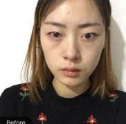 深圳富華醫(yī)療美容醫(yī)院眼部手術(shù)果咋樣!對比看案例果及價格價位明細