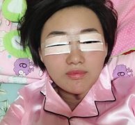 成都劉輔容眼部修復(fù)技術(shù)咋樣？雙眼皮整形案例如下，看就知道了