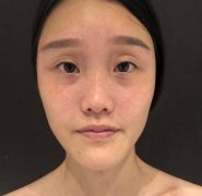 武漢同濟(jì)醫(yī)院整形科隆鼻案例+價(jià)格分享！果較為不錯(cuò)看圖吧！