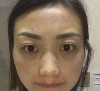 北醫(yī)三院整形科去眼袋怎么樣？手術(shù)前后對(duì)比圖真實(shí)記錄