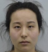 南京市婦幼整形科眼袋祛除果好嗎？案例實(shí)拍圖全告訴你