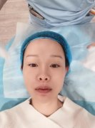 浙二整形科熱瑪吉果好嗎？看看案例圖就知道咋樣！