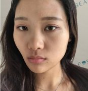 九院做熱瑪吉在哪個科？真實案例和價格收費來嘍~