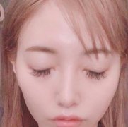 戴傳昌醫(yī)生做鼻子貴嗎？案例圖+上海九院價(jià)格價(jià)目表2021公示